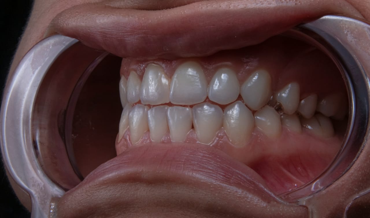 Gouttières dentaires sur mesure utilisées pour appliquer un gel blanchissant sur plusieurs séances à domicile.