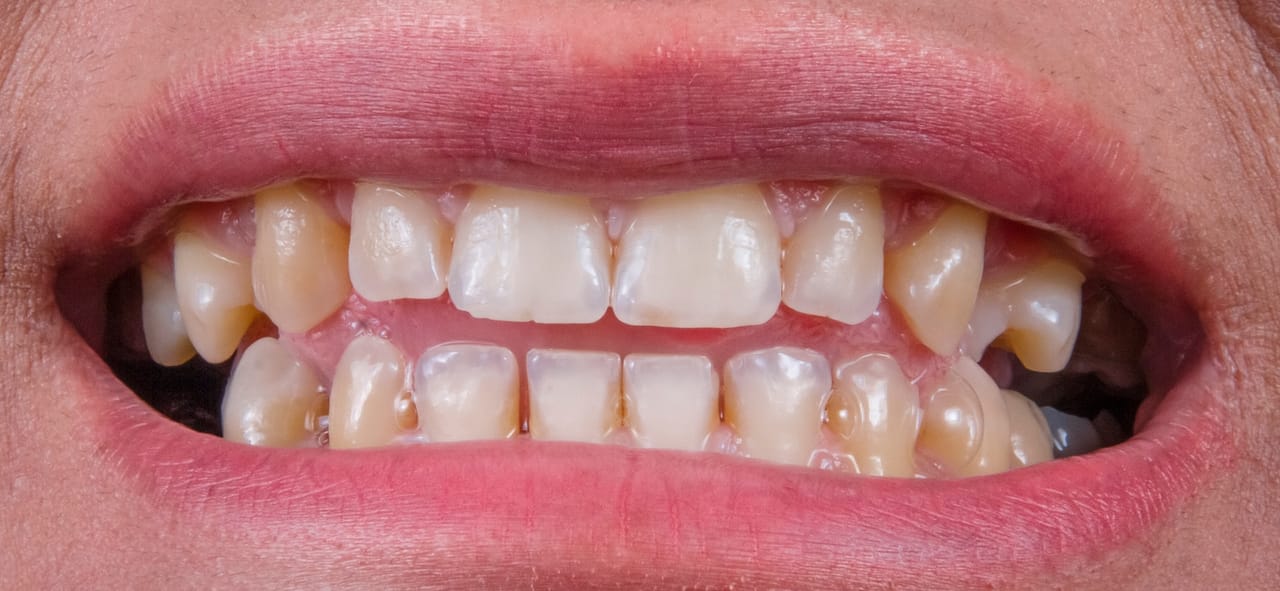 Image évoquant un blanchiment des dents pratiqué à la maison, sans déplacement chez le chirurgien dentiste.