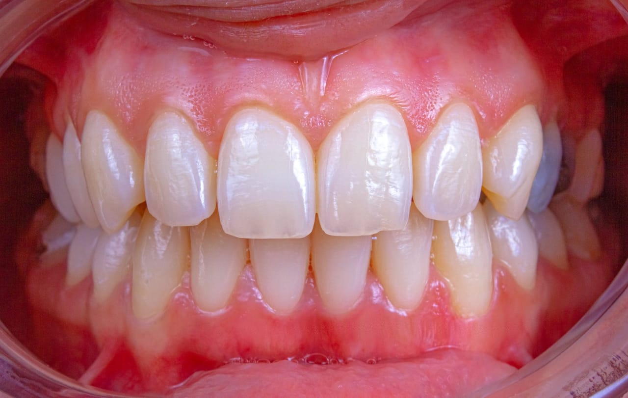 Sourire éclatant après blanchiment dentaire, illustrant la durée des effets d'un traitement d'éclaircissement des dents.