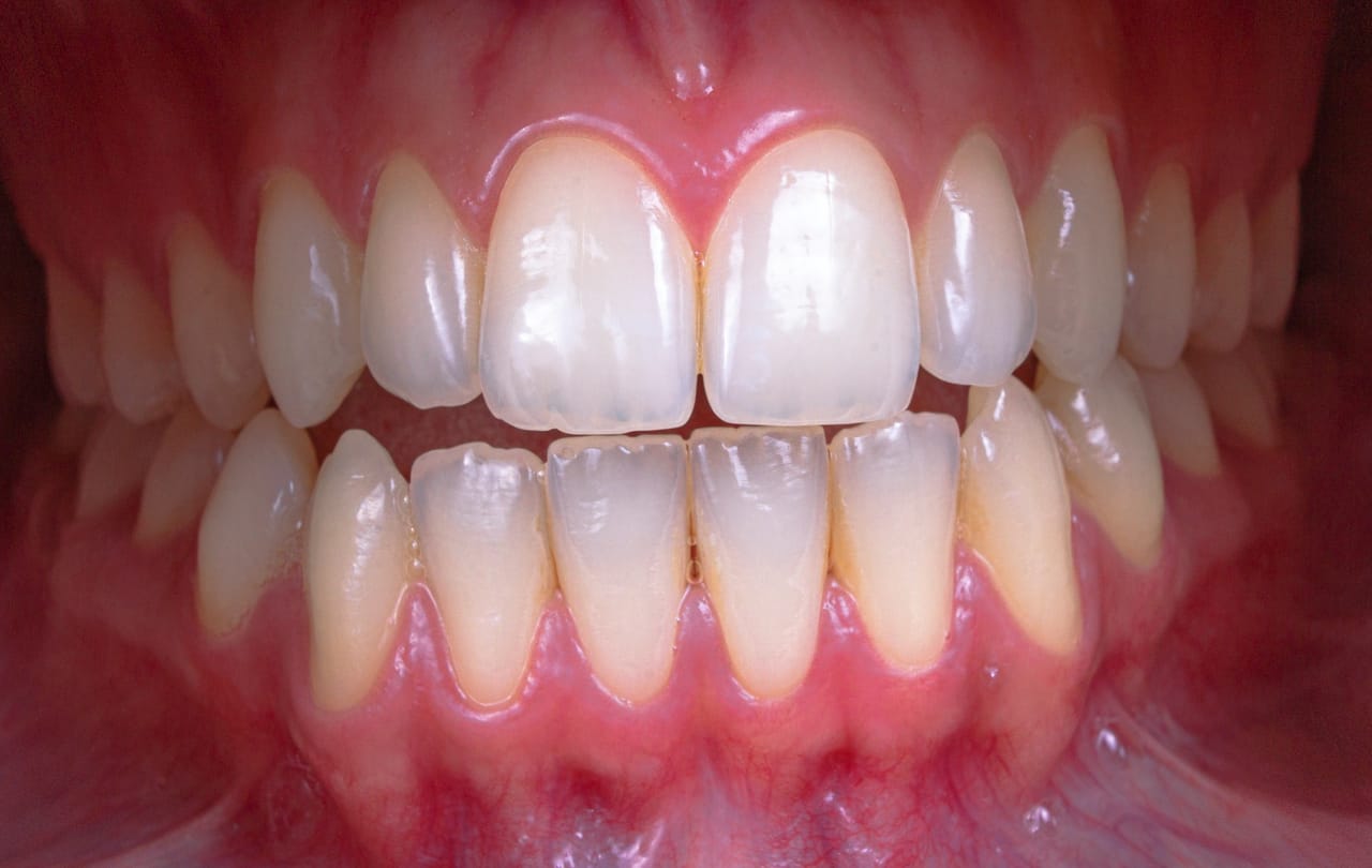 Bandes adhésives de blanchiment dentaire posées sur les dents, une méthode utilisable à domicile sans dentiste.