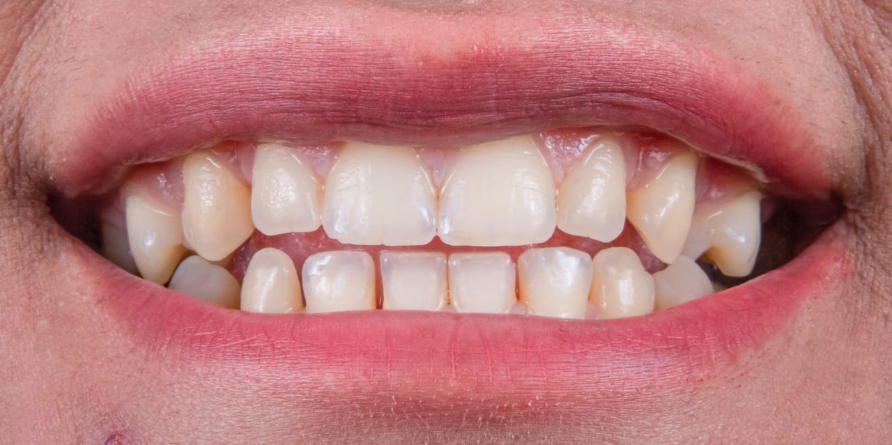 Cinq tubes de dentifrice blanchissant alignés sur un plan blanc pour un comparatif des meilleures marques du marché.