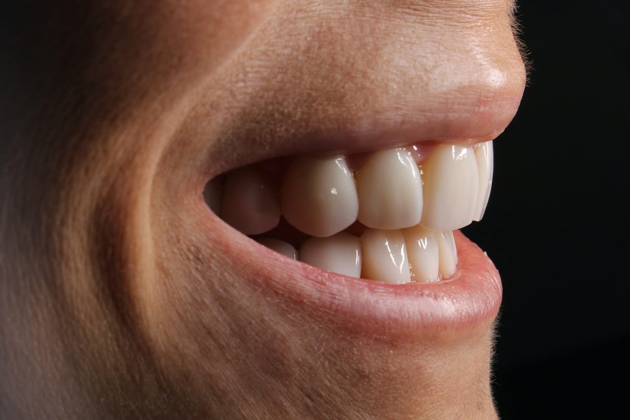 Comparaison visuelle entre différentes méthodes de blanchiment des dents, du cabinet dentaire à la pharmacie grand public.