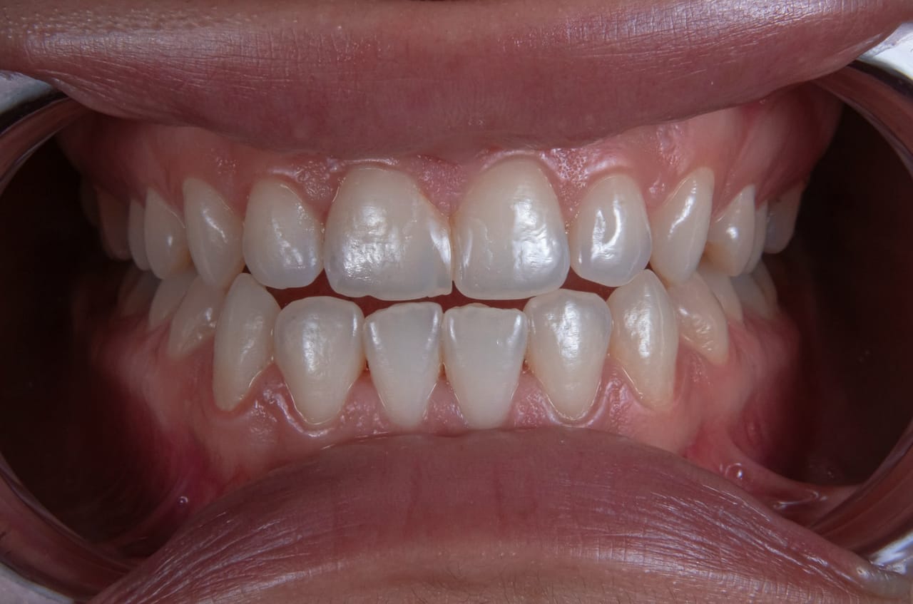 Dentiste préparant un protocole de blanchiment en cabinet, expliquant le nombre de séances nécessaires à son patient.
