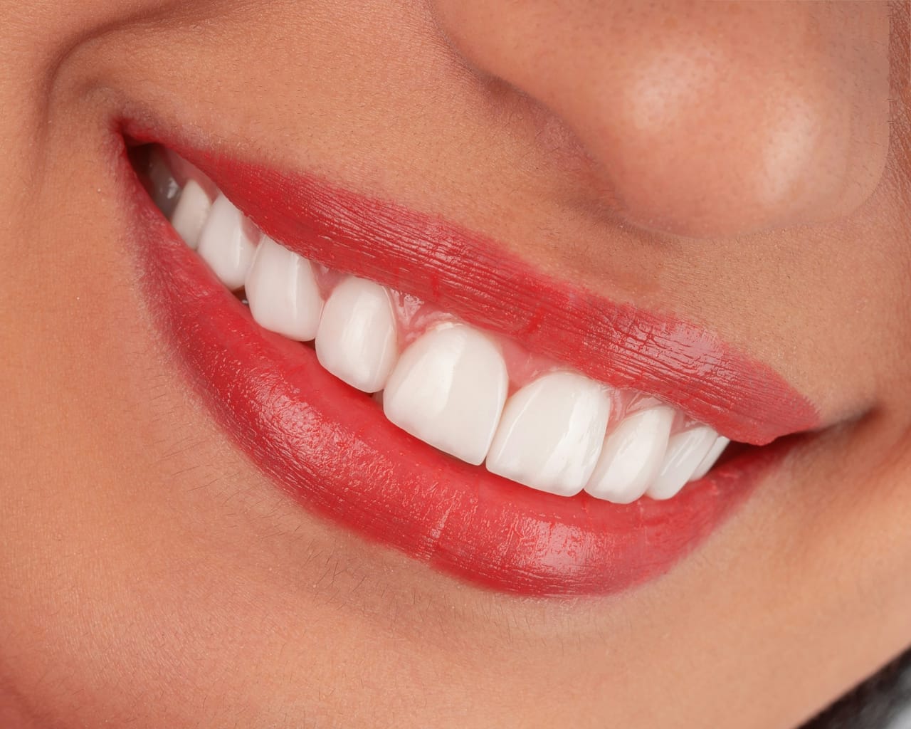 Sourire montrant des dents blanchies après traitement, pour illustrer les résultats réels d'un blanchiment dentaire.